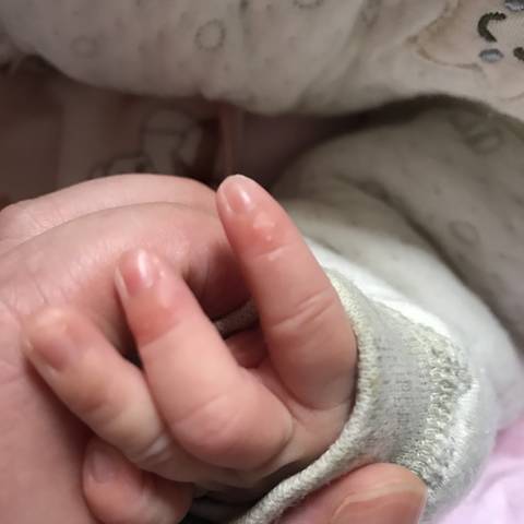 宝宝出生19天,今天发现手指和脚趾指甲下面长