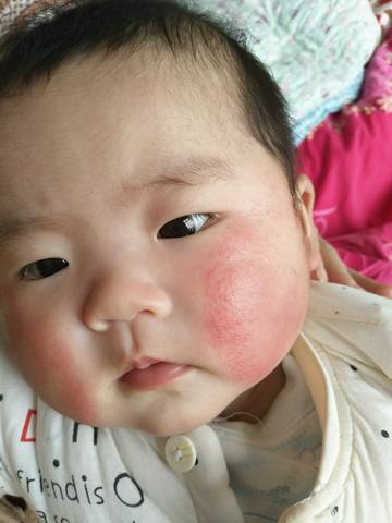 四个多月的宝宝脸上起的这是湿疹吗,还是用的