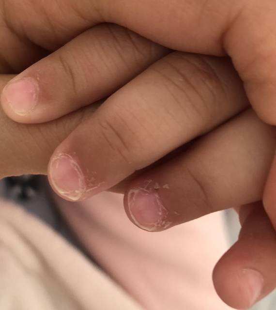 十个月宝宝指甲容易分层偶尔起倒刺