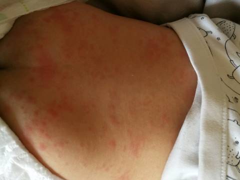 宝宝9个月发烧后长红疹,应该怎么理疗?