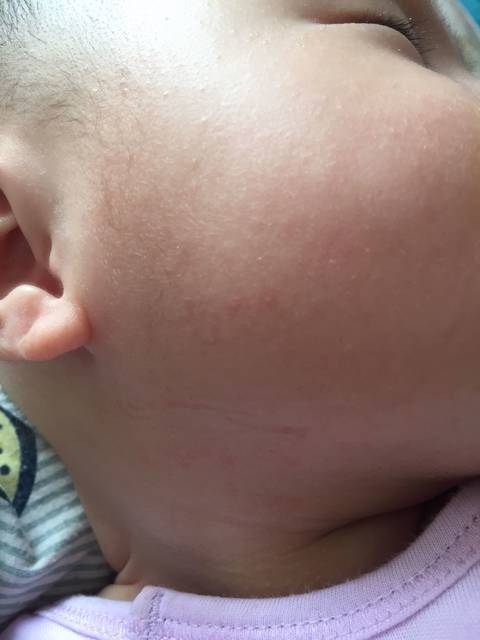 四个多月宝宝下巴跟脖子长了小红疙瘩 可以用