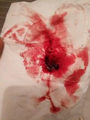 清宫一个月了,现在是第一次来的月经,比之前的