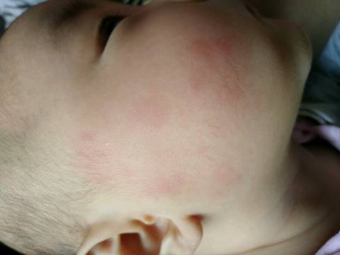 四个月宝宝身上长很多像蚊子咬一样的红包, 前