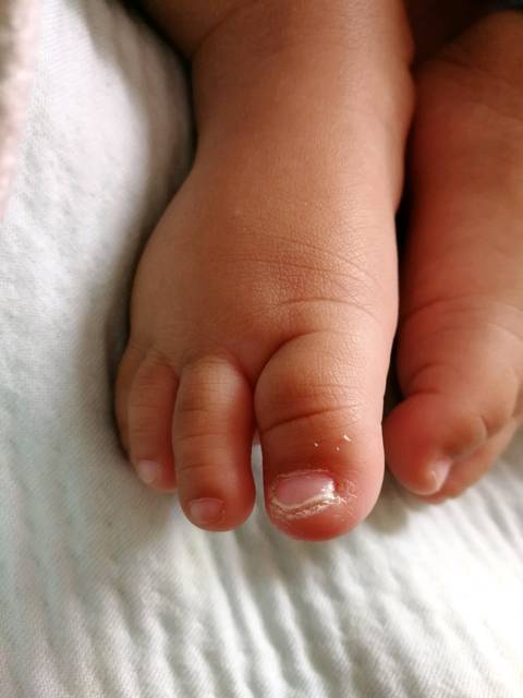 宝宝脚趾甲变白变厚