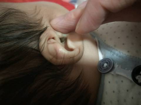 宝宝耳朵里长了一个疙瘩。和小泡泡似的,两边