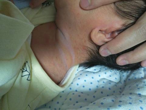 小宝出生8天,有点消化不良。昨天身上出现红斑