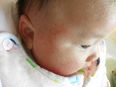 宝宝脸上湿疹,严重,从月子就有,现在三个多月了