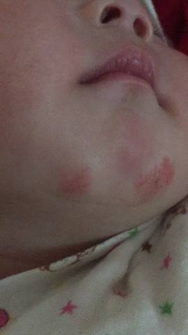 宝妈们我家宝宝四个多月了,脸上长了像藓一样