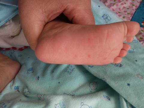 宝宝脚心起小红疙瘩,其中有一个像水泡,小臂上