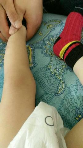 快一岁宝贝,小腿弯曲,人家俗称:箩筐腿,缺钙原因