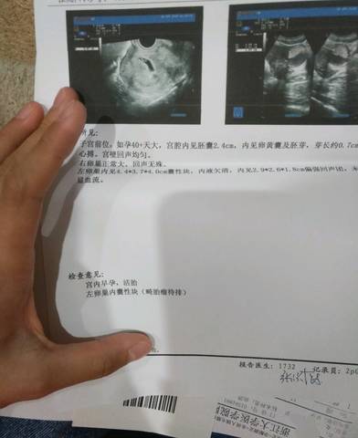 怀孕前几天检查出来有囊肿,医生让月经来的第