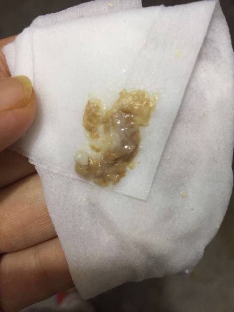 滴虫性阴道炎怎么办!我哭了!求助