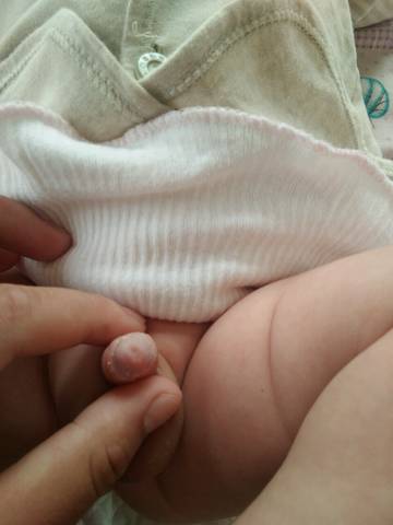 我家孩子小JJ这样正常吗?