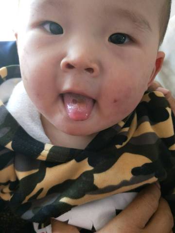 我家宝宝一岁三个月,今天发现宝宝舌头上一块
