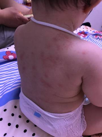请问宝宝一热身上就起这样的红点,一凉快就消