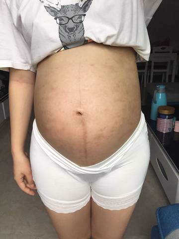 之前皮肤过敏所以导致肚子有好多印 怀孕七个