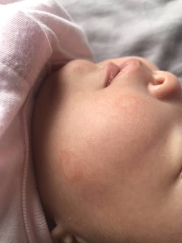 宝宝脸上长了两块红斑 不知道是湿疹还是癣 请