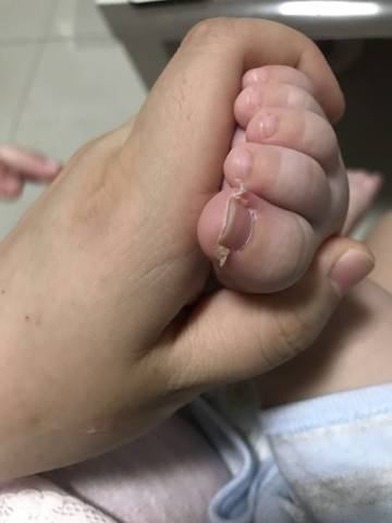 宝宝四个月脚趾头指甲两边硬,而且今天有点脱皮