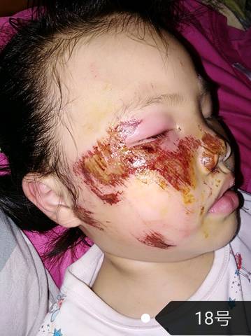 怎么办怎么办,孩子脸上以后留疤怎么办,