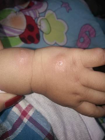 宝宝被蚊子咬了起水泡脓包是怎么回事?
