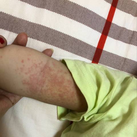 这到底是痱子还是湿疹呢?宝宝快七个月了