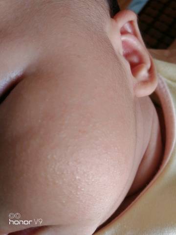 宝宝脸上长了很多透明的小颗粒,怎么办