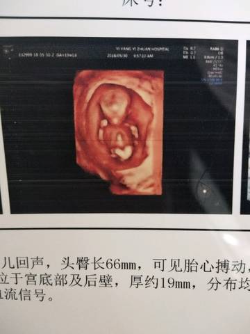 朋友们 ,能不能看出这是男孩还是女孩,哈哈,三个月检查nt