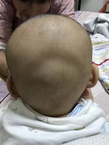 宝宝这样偏头扁头严重吗?要怎么办,三个月了,