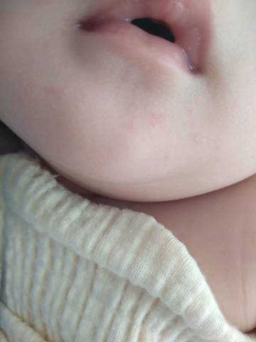 宝宝嘴巴周围长了这些小红点,是什麼?