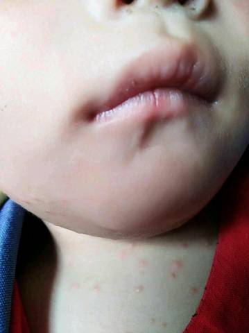 小孩一岁零三个月身上出的痘痘一个月了反反复