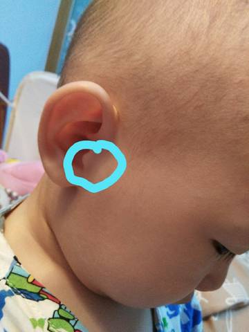 我儿子一岁八个月,最近这两天右耳朵痛,轻轻一