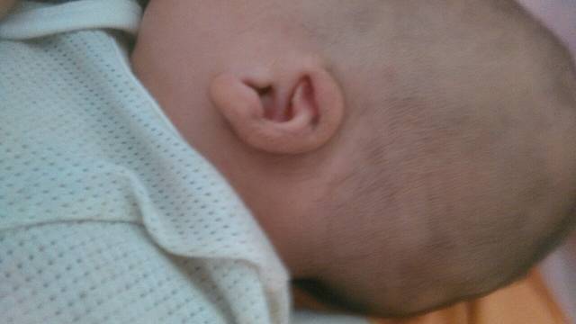 婴儿两个月耳朵软骨在出生15天压扁了,求矫正