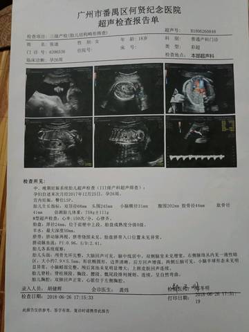 医生说胎儿左心室有强光点,和有个囊肿,说的好
