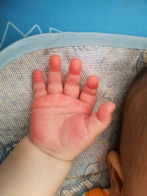 4个月宝宝手掌心红
