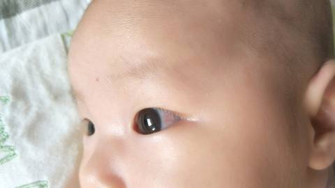 我家宝宝今天66天,左眼白眼珠里有红血丝是怎