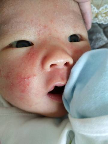 宝宝21天了,脸上就是长痘痘,像青春痘一样,不知
