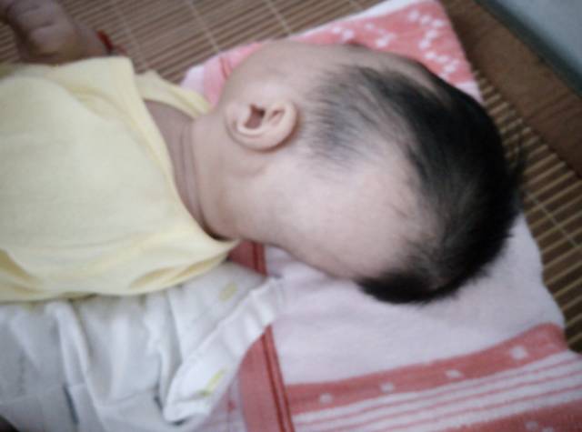 宝宝快三个月了睡成扁头了怎么办。