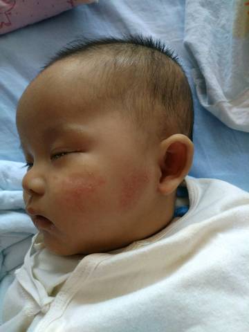 我家宝宝两个月了,脸上一直有红疹子样的东西