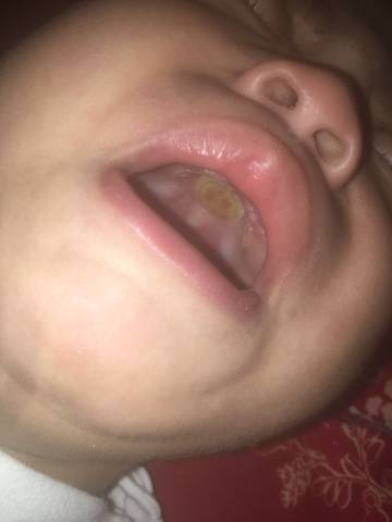 一岁三个月宝宝了,十个月就发现口腔上颚长了一块不硬