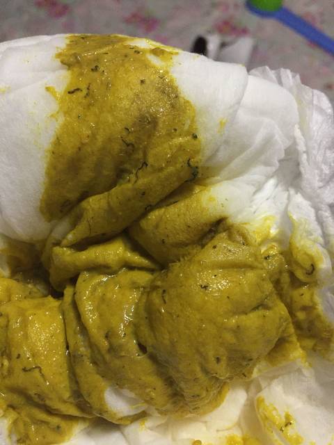 刚加辅食拉的屎,为什么有些黑色东西?