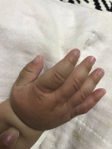 一觉醒来五个月的宝宝手肿成这样了,好担心,今天观察了一天还是没有