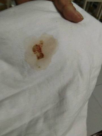 宝宝上午拉黑色粑粑,下午吃完奶吐奶怎么还带