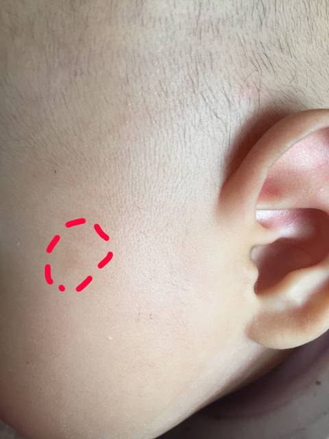 蚊子咬了以后有黑印