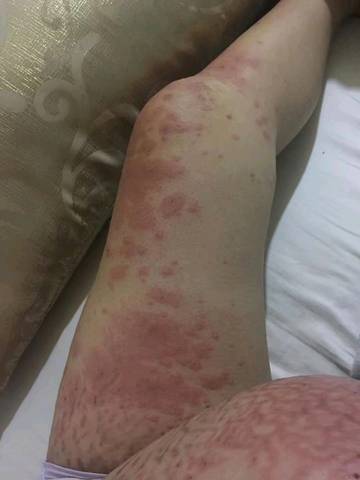 他们说是羊水过敏,不知道是不是?老大7个左右