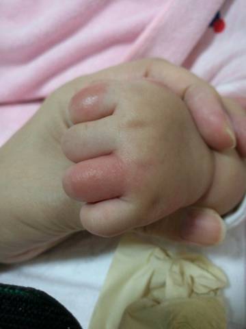 三个月的宝宝手掌突然有好几处红肿,摸上去硬硬的.