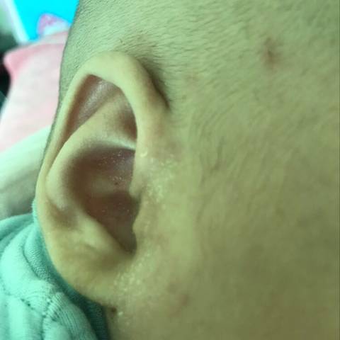 宝宝两个月耳朵周围长的像癣一样的东西,这个是湿疹还是奶癣啊?