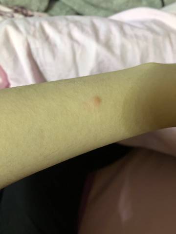 上的疹子,像是被虫咬,疹子周围一圈皮肤也痒,目