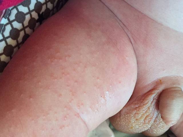 新生儿腿上有疹子。不晓得是啥。如何治愈。