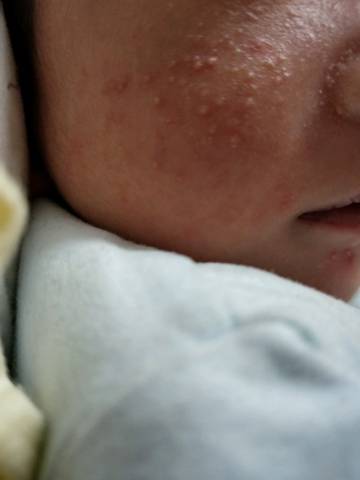 新生儿脸上长痘痘有小白点是什么情况?