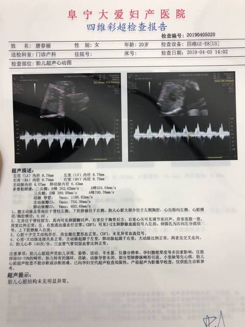 糖塞,四维,心超一次性通过!宝宝真给力!